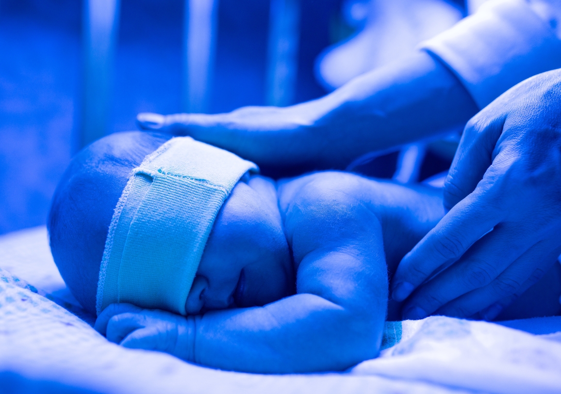 Bayi baru lahir menjalani fototerapi, terapi cahaya yang direkomendasikan secara medis untuk menurunkan kadar bilirubin pada kasus bayi kuning.